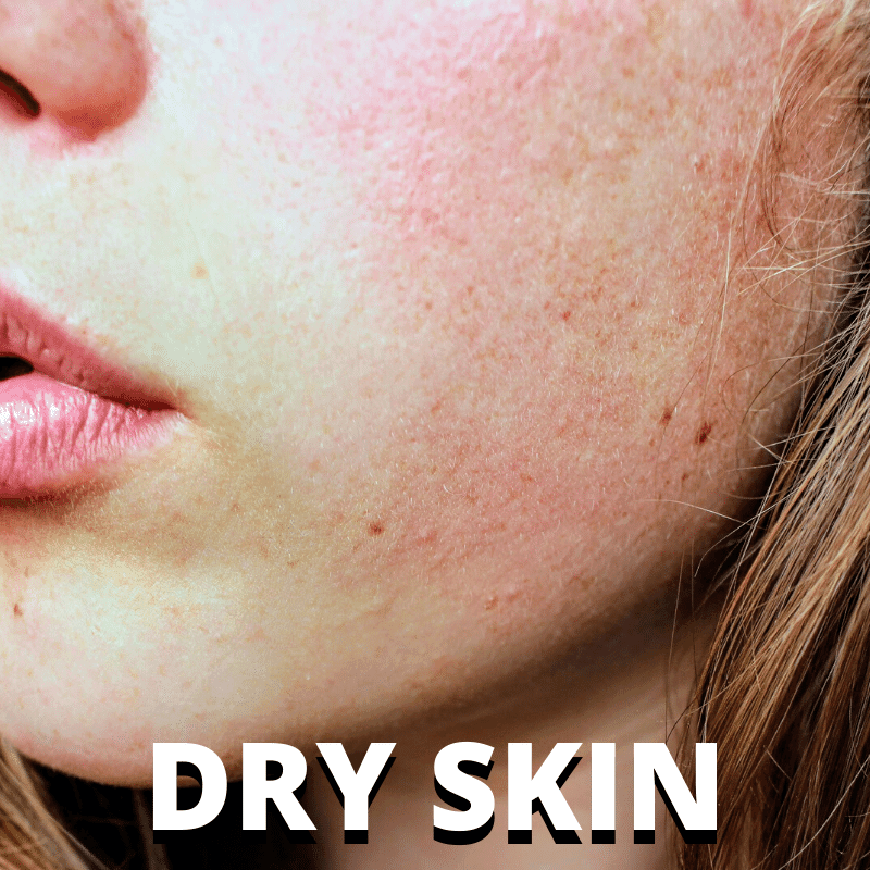 Dry Skin - Dermafirm USA