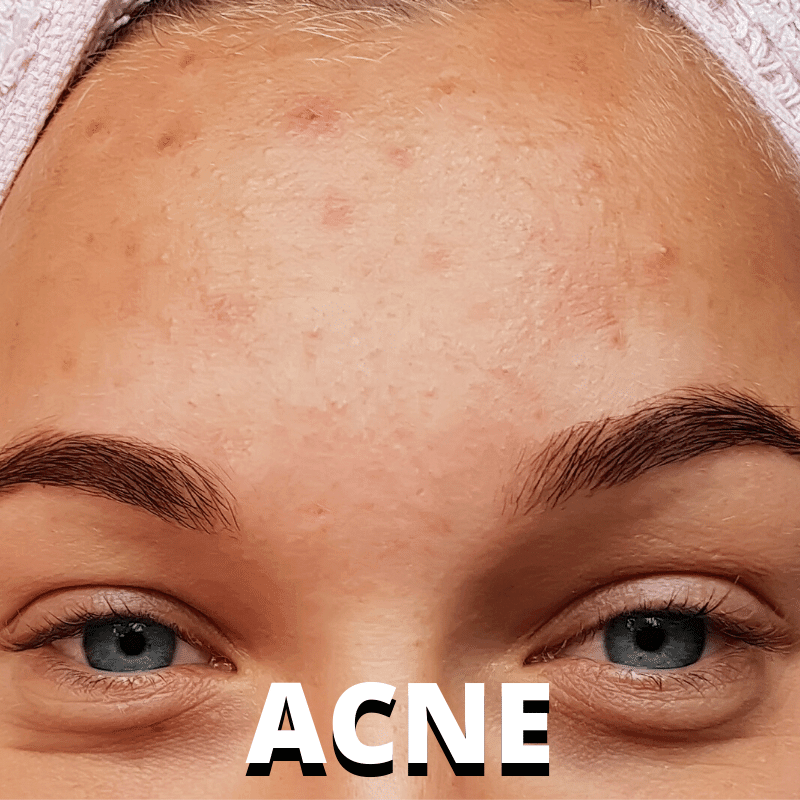 Acne - Dermafirm USA