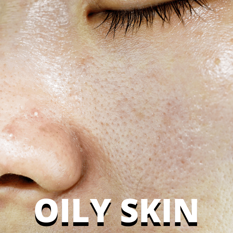 Oily Skin