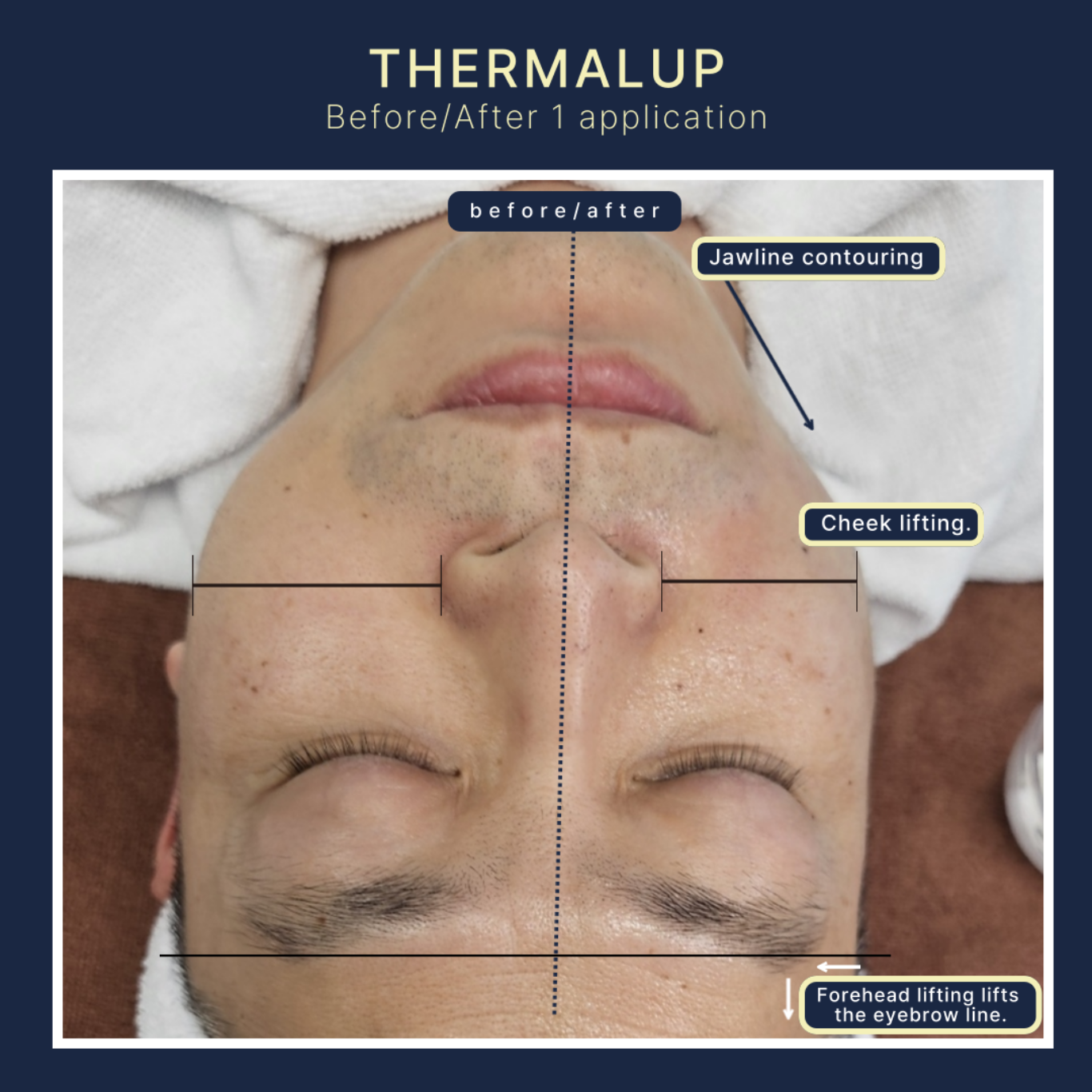 Thermal Up – RF Lifting & Sculpting System