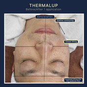 Thermal Up – RF Lifting & Sculpting System