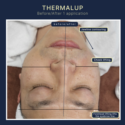 Thermal Up – RF Lifting & Sculpting System
