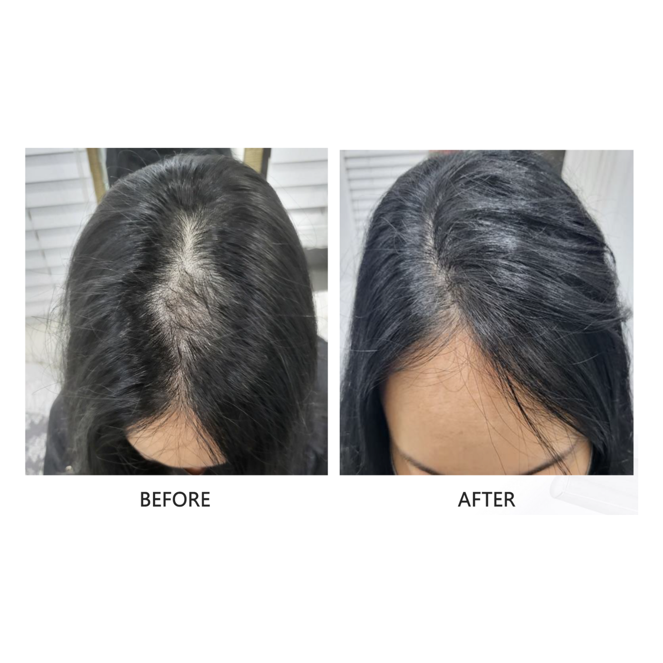 FollicleBoost ProFusion - (AP IIT 5ml x 5 + ISCE 2ml x 5 Combo Kit)