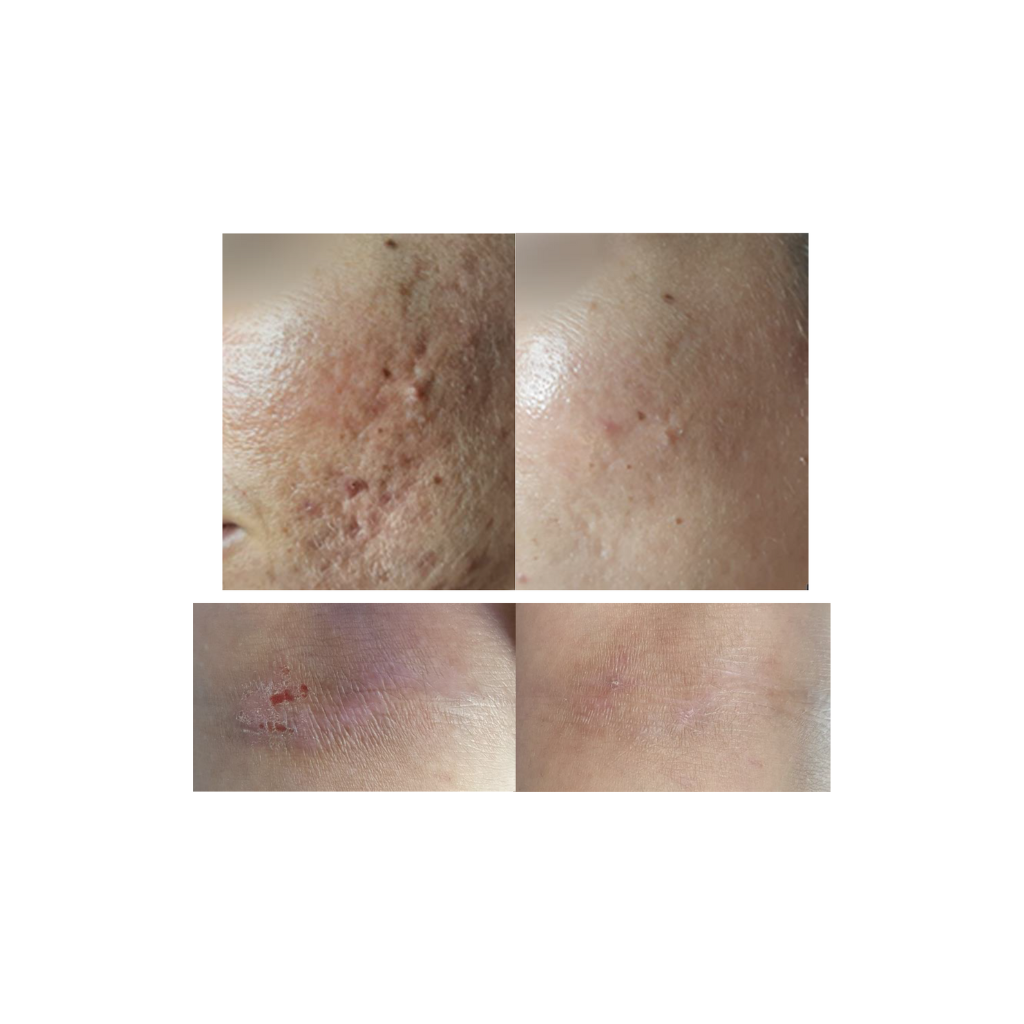 Cold Plasma Beauty Device - DR PLATON