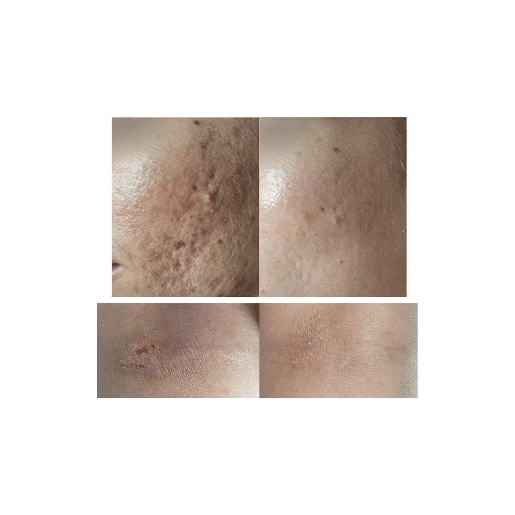 Cold Plasma Beauty Device - DR PLATON