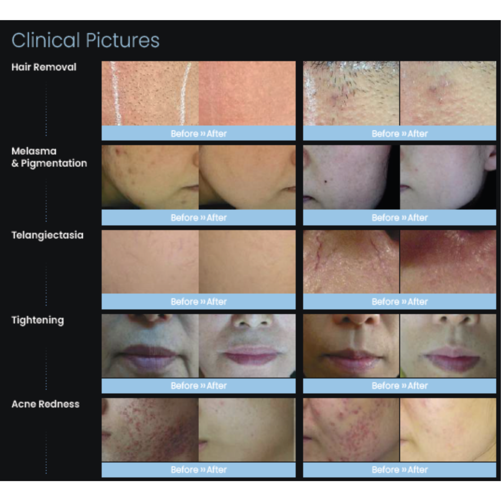 Nobleen Dual Long-Pulsed Alexandrite & Nd:YAG Laser