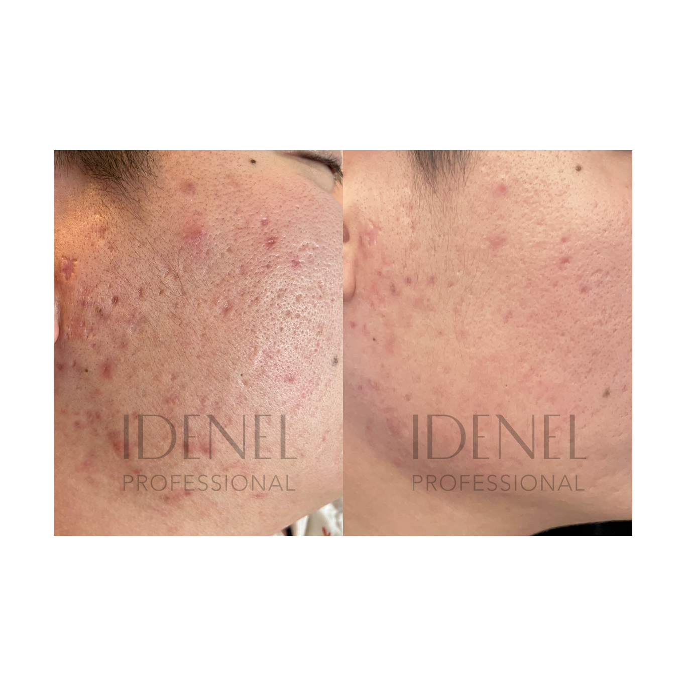 IDENEL - Revitalizing Nourishing Cream (10ml x 2)