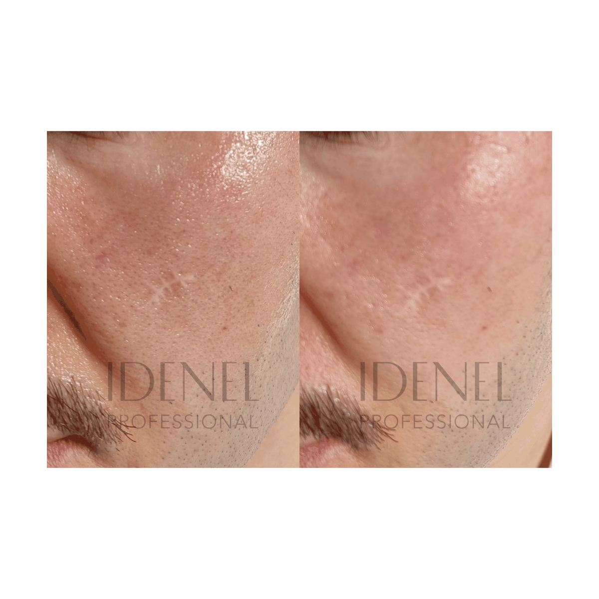 IDENEL - PEPTAXEL (Trouble Solution Powder "Green" + Brightening "Yellow" Package: 10 Vials - 5 Vials of 1g + 5 Vials of 8ml)