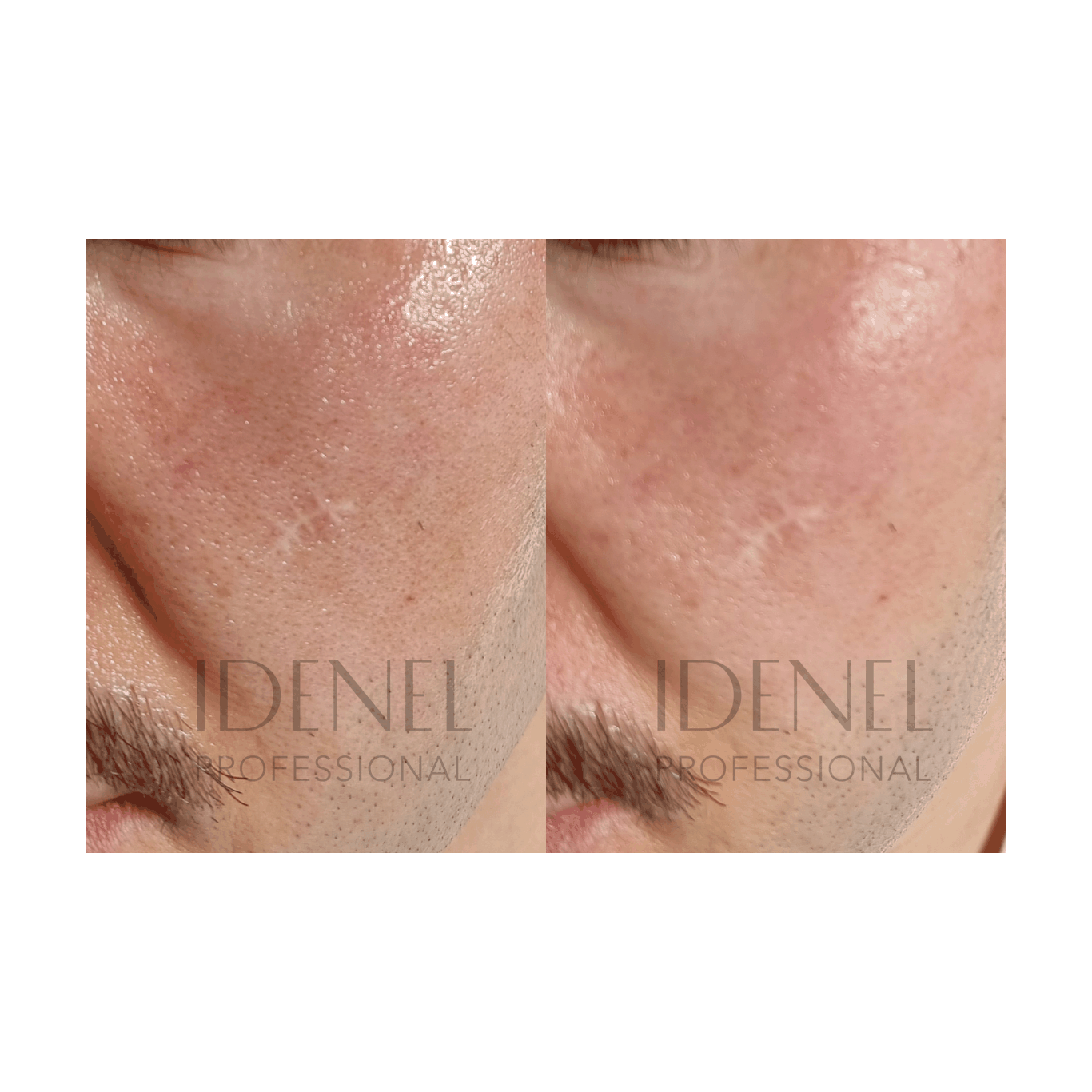 IDENEL - PEPTAXEL (Trouble Solution Powder "Green" + Brightening "Yellow" Package: 10 Vials - 5 Vials of 1g + 5 Vials of 8ml)