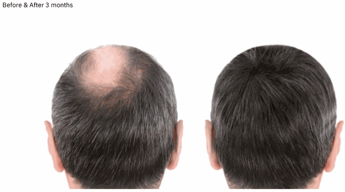 Laudem LaserHelmet Pro (Laser Diodes) - FDA-Cleared 510K