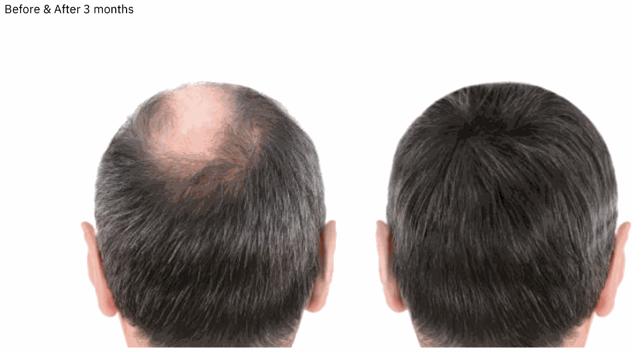 Laudem LaserHelmet Pro (Laser Diodes) - FDA-Cleared 510K