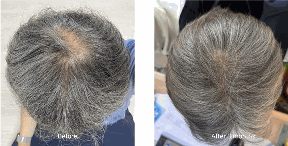 Laudem LaserHelmet Pro (Laser Diodes) - FDA-Cleared 510K