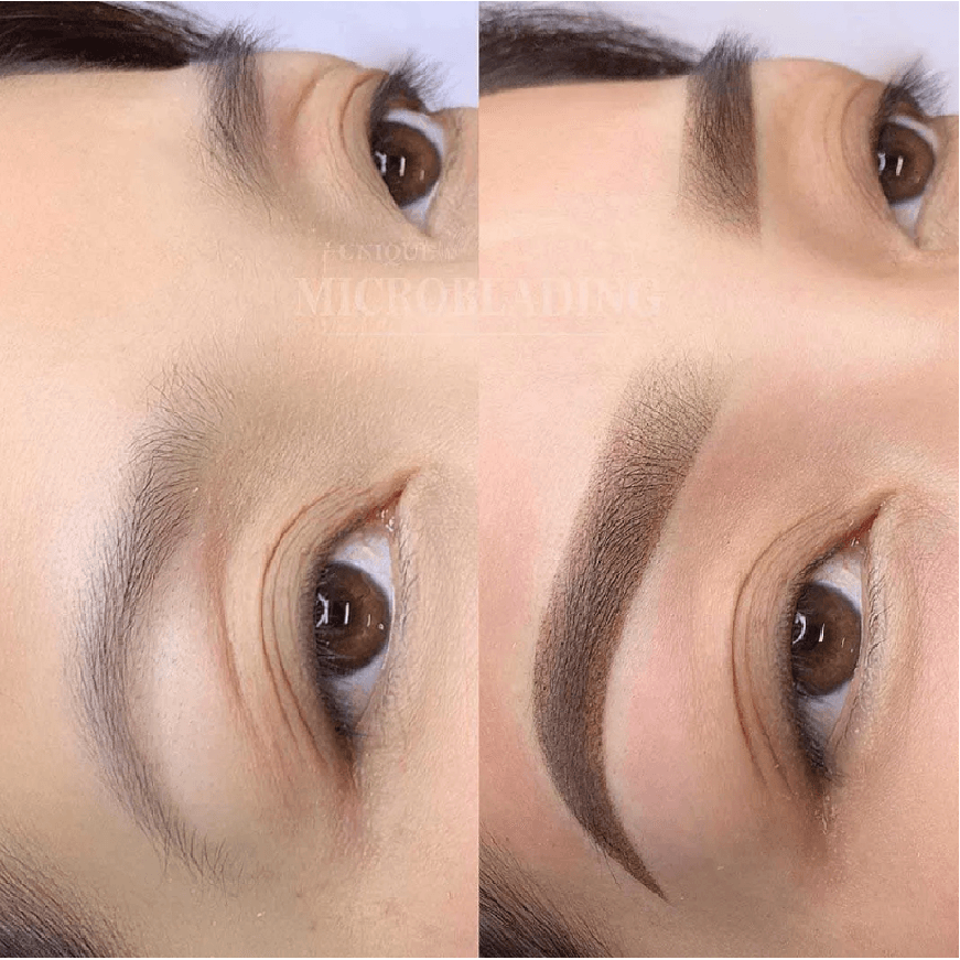 Staccato - Scalp Micropigmentation (SMP) Machine - Dermafirm USA