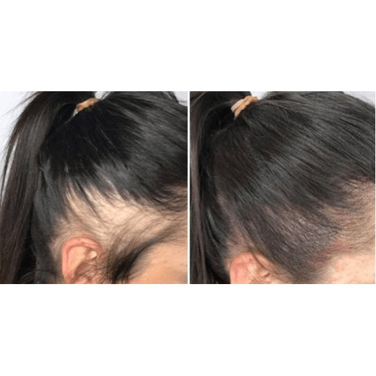Staccato - Scalp Micropigmentation (SMP) Machine - Dermafirm USA